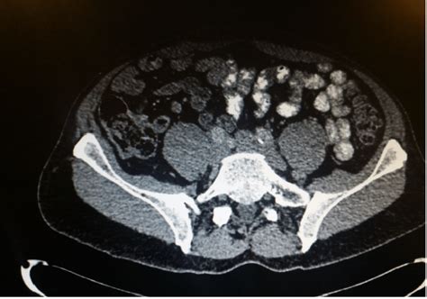 Ct Scan Of Abdomen And Pelvis Post Operatively Note No Resdiual
