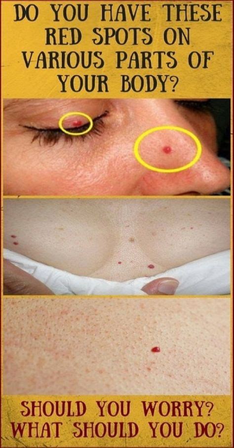 Do You Have These Red Spots On Various Parts Of Your Body Redspots