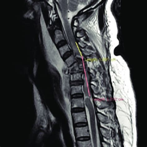 E Extend Of Spinal Cord Edema From C2 To C7 Download Scientific Diagram
