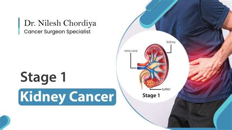 Stage 1 Kidney Cancer Symptoms Diagnosis And Treatment