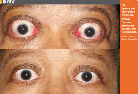 Study Therapy Reduces Proptosis Diplopia In Ted Ophthalmology Times