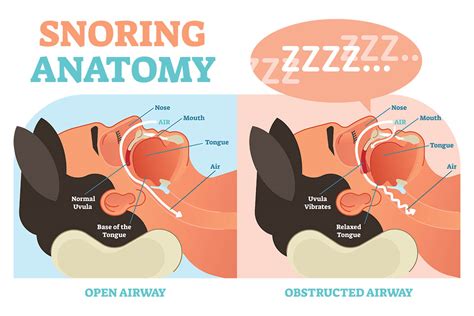 Snoring And The Dentist Sleep Apnoea Snoring Treatments