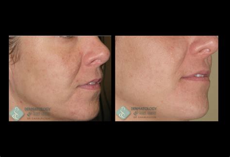 Non Ablative Fractional Skin Resurfacing Dermatology And Laser Center