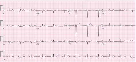 Carolinas Ekg Blog Cmc Compendium