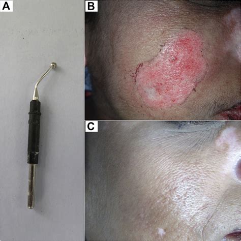 Electrofulguration Assisted Dermabrasion For Recipient Site Preparation