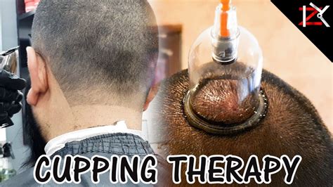 How To Cure Headaches Wet Cupping Therapy Performed Migraine Treatment Hijama This