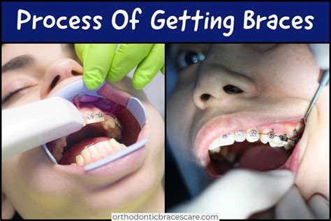 When the procedure is completed, you will be free to leave. Process Of Getting Braces: Steps, How Long It Takes ...