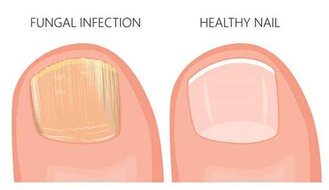 Toenail Falling Off Causes What To Do How To Remove It