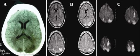 A Ct Scan Of Brain Showing Well Defined Hypodense Areas In Bilateral
