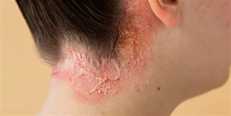 Psoriasis Before And After What To Expect During Treatment