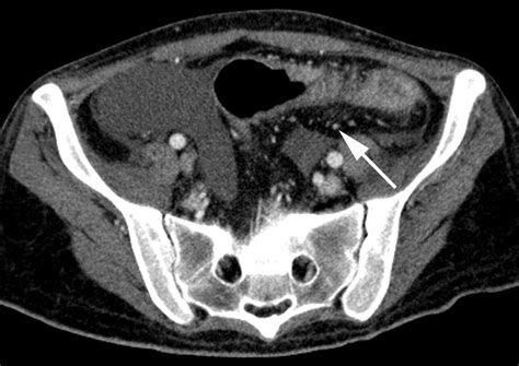 Ulcerative Colitis Radiographics