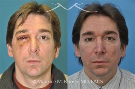 New York Facial Fracture Repair Maurice M Khosh Md Facs
