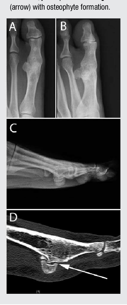 Figure 1 From Simultaneous First Metatarsophalangeal Joint Arthrodesis