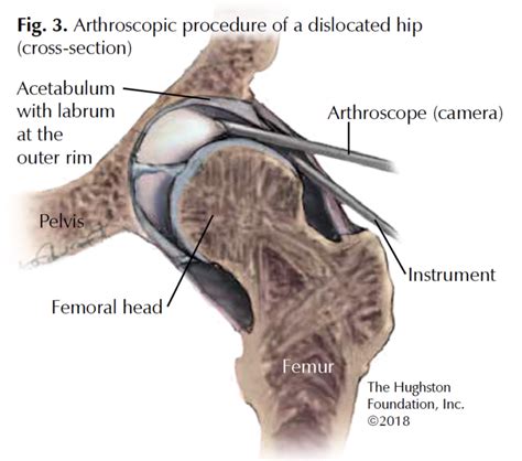 Hip Arthroscopy Hughston Clinic