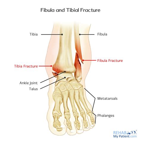 Fibula And Tibial Fracture Rehab My Patient
