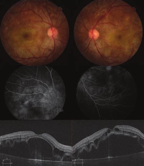 Fundus Photographs Fluorescein Angiography And Optical Coherence