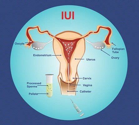 Intra Uterine Insemination IUI Fertility Specialist In Thane