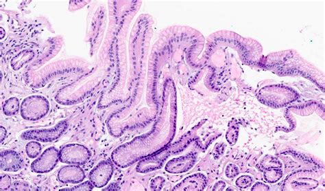 Pathology Outlines Gastric Antral Vascular Ectasia