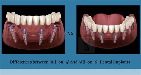 The Difference Between ‘all On 4 And ‘all On 6 Dental Implants
