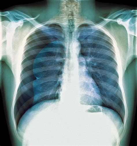 Pneumothorax X Ray Photograph By Du Cane Medical Imaging Ltd
