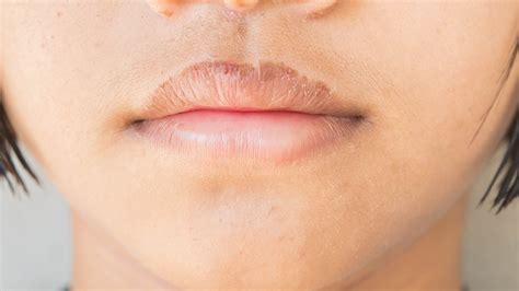 Psoriasis On Lips And Nose