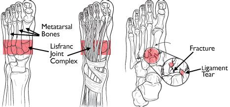 A lisfranc injury is often mistaken for a simple sprain, especially if the injury is a result of a straightforward twist and fall. What do Napoleon and a Gynecologist have to do with Taysom ...