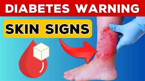 Reveal 13 Critical Skin Symptoms Hinting At Diabetes Risk Health