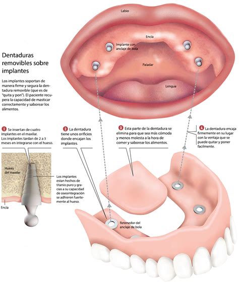 Dentaduras Removibles Sobre Implantes