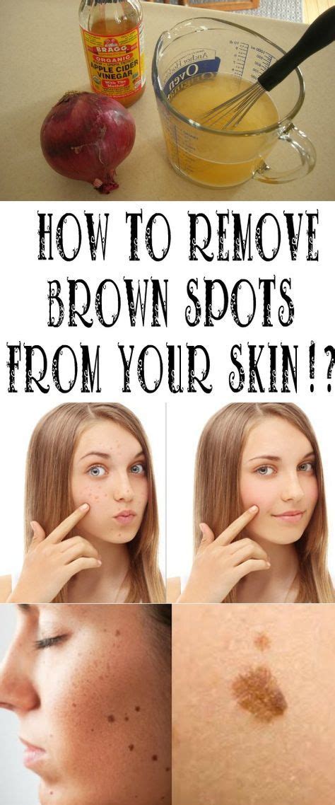 How To Remove Brown Spots From Your Skin