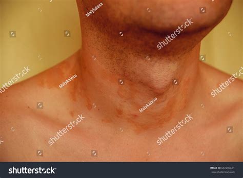 Allergic Skin Rash Spots On Neck Stock Photo 682209631 Shutterstock