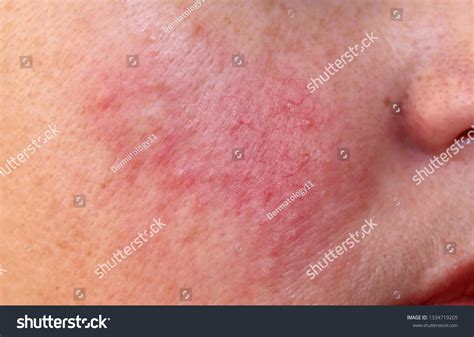 Case Early Rosacea On Womans Face Stock Photo 1334719205 Shutterstock
