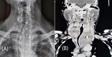 Scabbard Trachea In Medullary Thyroid Cancer Bmj Case Reports