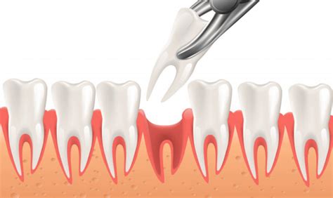 Tooth Extractions Everything You Need To Know
