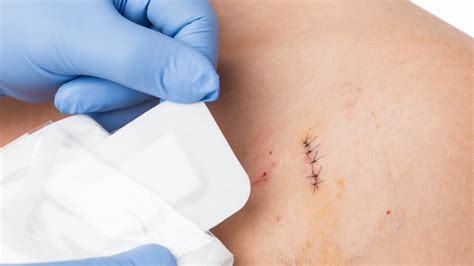 How To Know If A Cut Needs Stitches Or Not University Urgent Care