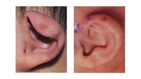 Constrictedlopcup Ears Childrens Hospital Of Philadelphia