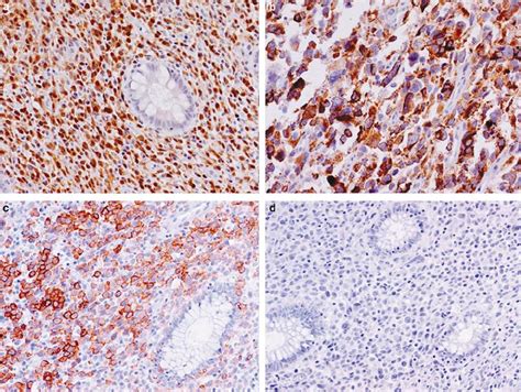 Immunohistochemistry Of Metastatic Melanoma In The Colon The Tumor