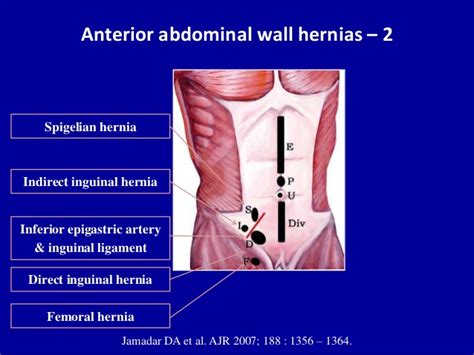 Ultrasound Of The Abdominal Wall Hernias Abdominal Umbilical Hernia