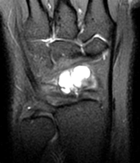Ganglion Cyst Wrist X Ray