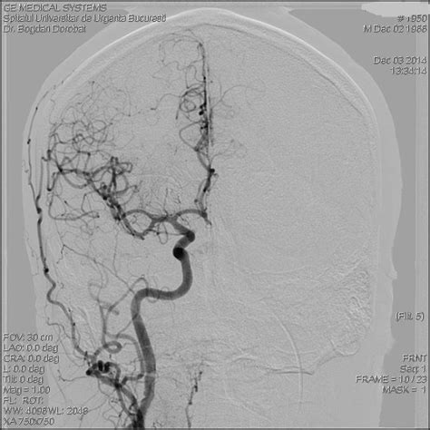 5 Cerebral Angiography A Right Carotid Artery B Left Carotid