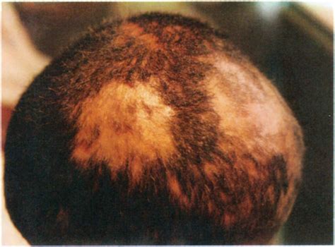 Scalp Fungus Infections In The Eastern Provinceof Saudi Arabia Annals