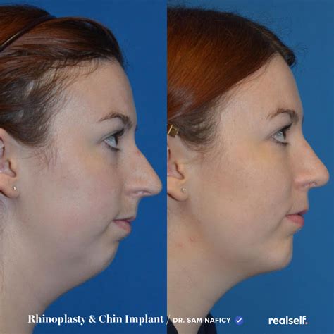 5 Facts About Chin Implants In 2020 Chin Implant Implants Chin