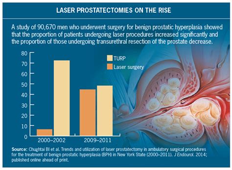 Laser Surgery Gaining On Transurethral Resection Turp For Enlarged