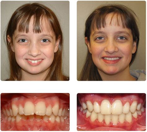 How To Fix Overbite Without Surgery Cardsdental 2023