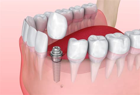 Dental Implant For Single Tooth Replacement East Honolulu Hawaii Kai