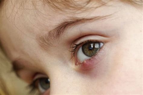 Eye Stye Sty What Is It Causes And Treatment