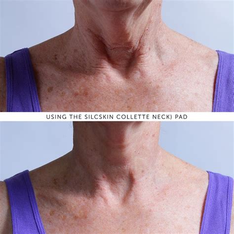 Pin By Silcskin On Silcskin Anti Wrinkle Pads Wrinkle Treatment