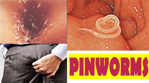 Itchy Anus Parasites Symptoms Treatment Itchy Bottom