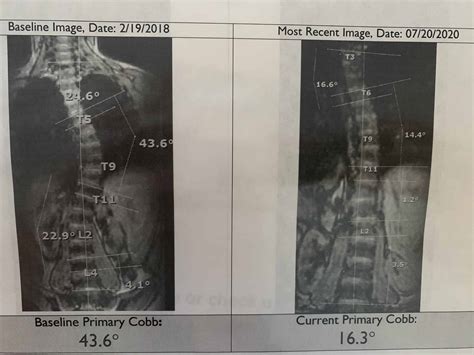 Our Scoliosis Story The Art Of Thriving