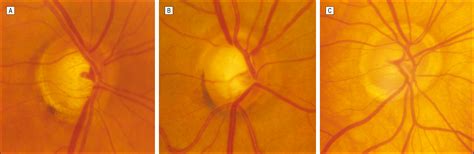 Peripapillary Choroidal Thickness In Healthy Controls And Patients With