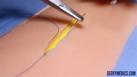 Subcuticular Suture Osce Guide Surgical Skills Geeky Medics